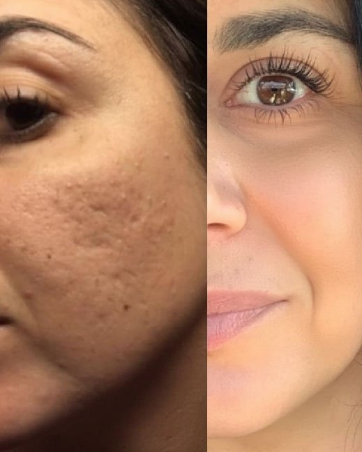 co2 fractional laser resurfacing 08