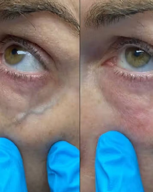 laser for vascular lesions 06