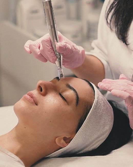 microneedling for face