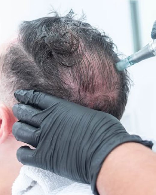 microneedling for hair 04