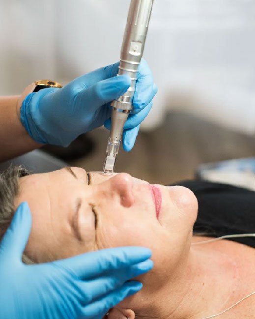 microneedling for scars & stretch 05
