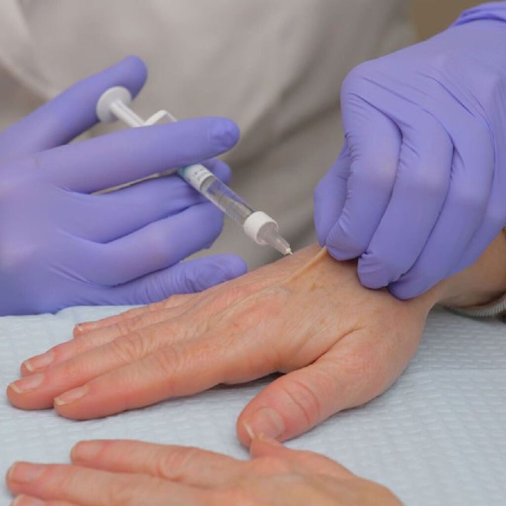 dermal fillers for handss 02